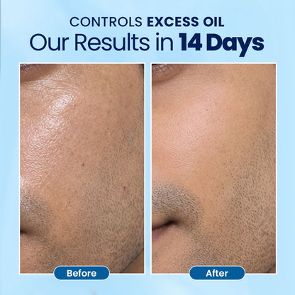 AcneFix Hydration Moisturizer for Men-50 ml | For Oily Skin to Normal Skin