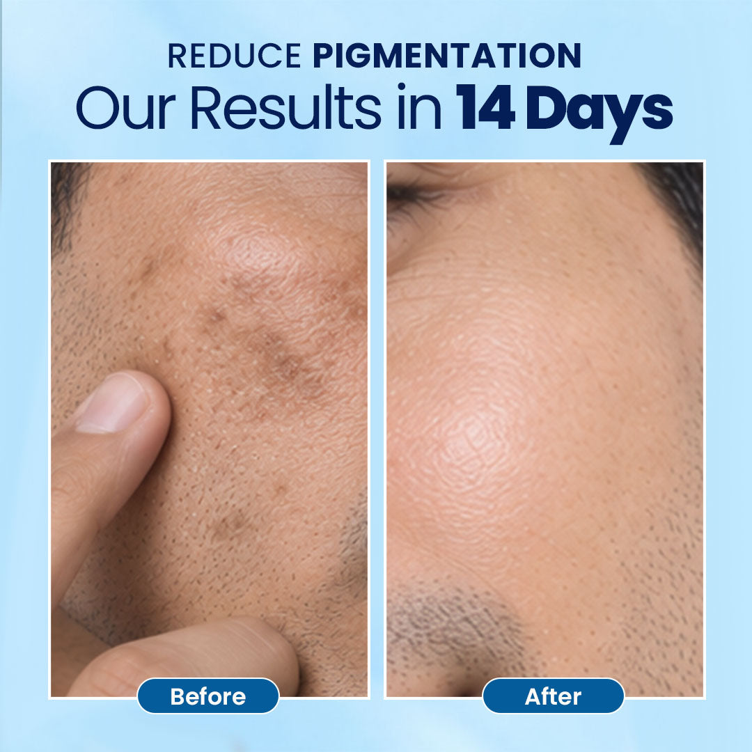 AcneFix Hydration Moisturizer for Men-50 ml | For Oily Skin to Normal Skin